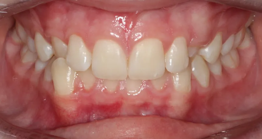 Patient's teeth before treatment