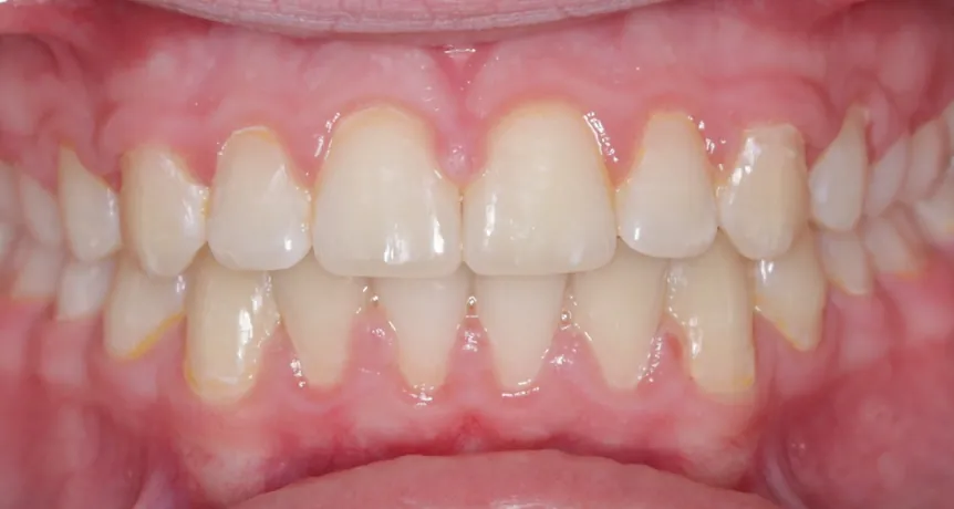 Patient's teeth after treatment
